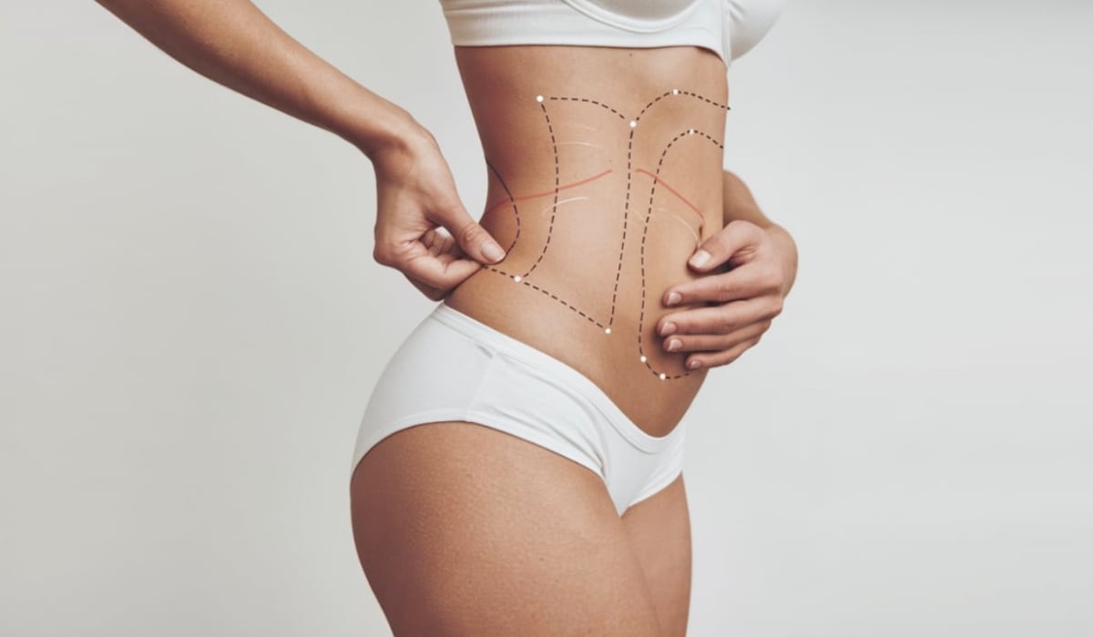 Quels sont les avantages d’une liposuccion ?